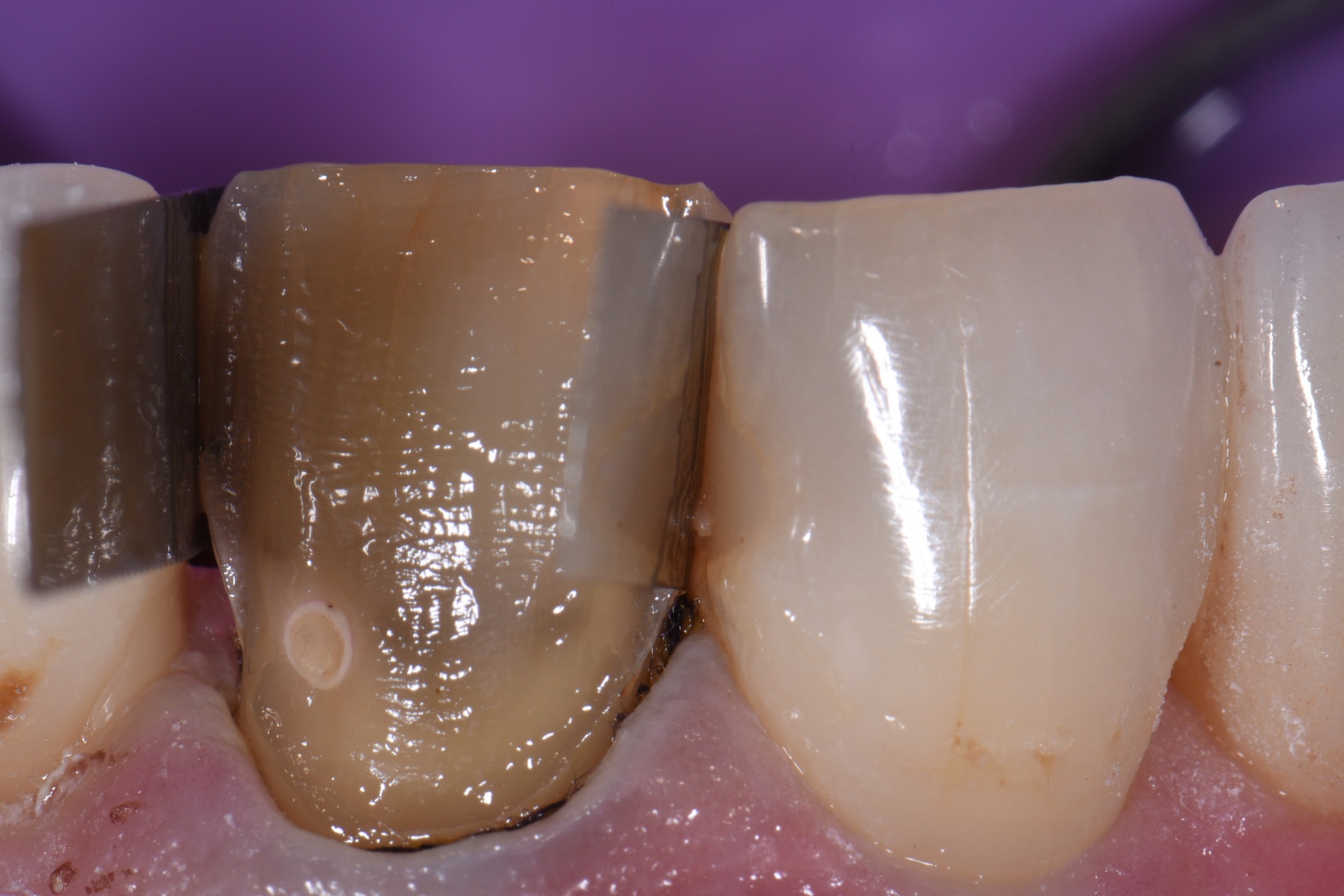 Lightening a dark tooth with composite resin artistry