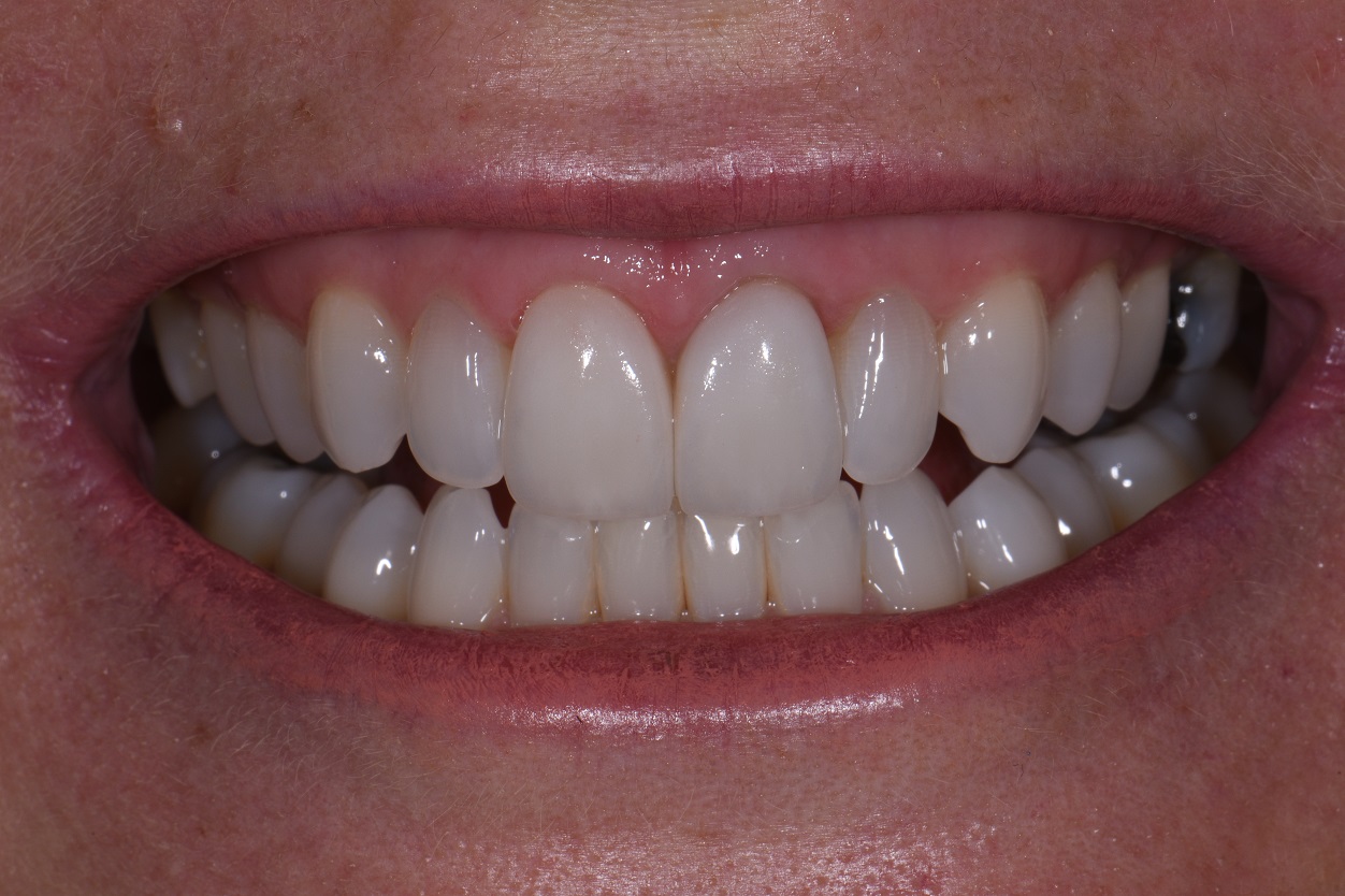 Porcelain Veneers & Crowns Complex Anterior Bonded Dentistry