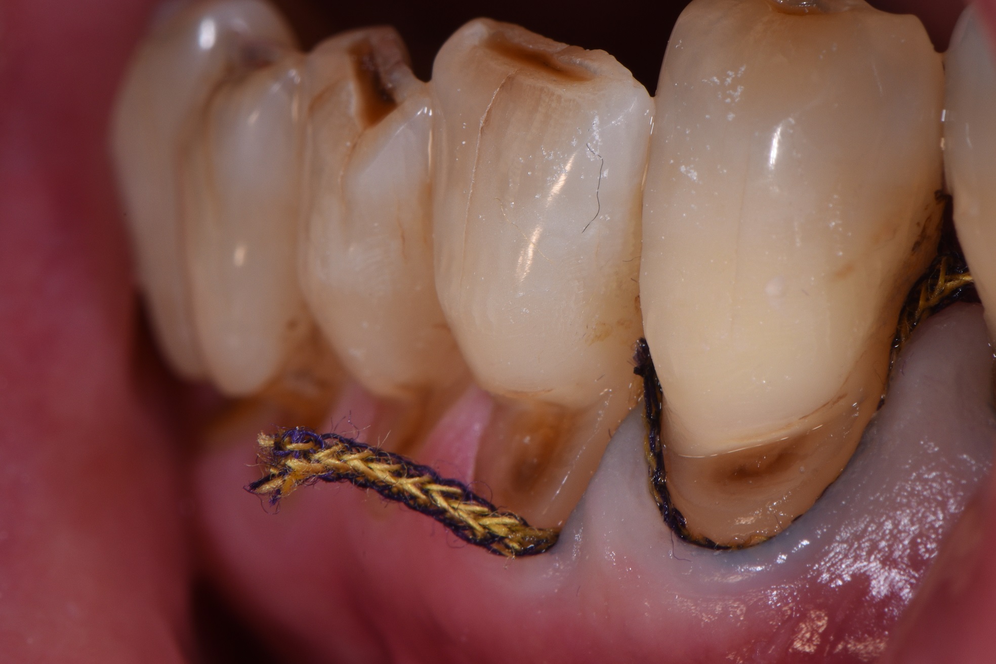 Turn Back Time with Tooth Wear Cosmetic Dentistry New Zealand