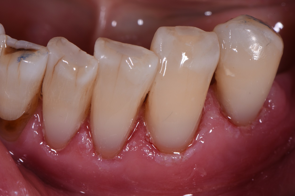 Turn Back Time with Tooth Wear Cosmetic Dentistry New Zealand