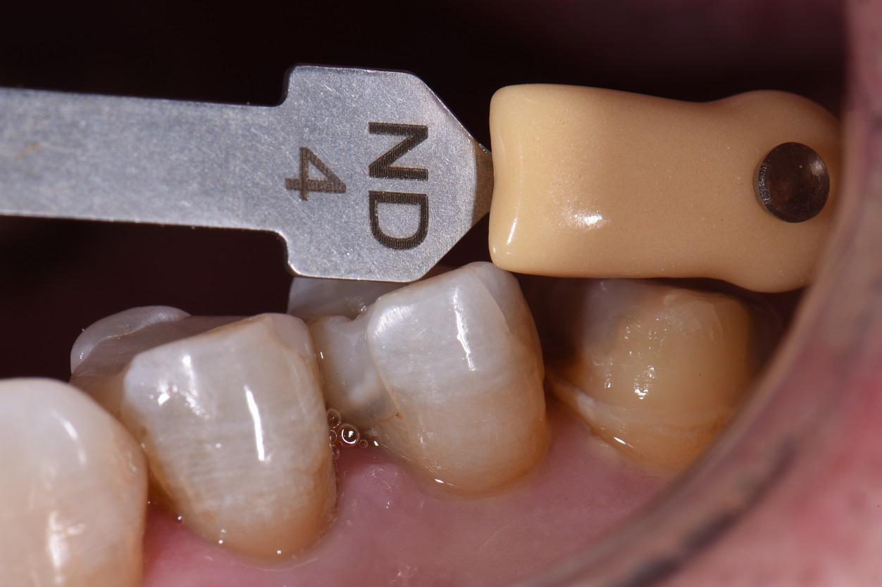 Temporary Crowns Mimicking Nature