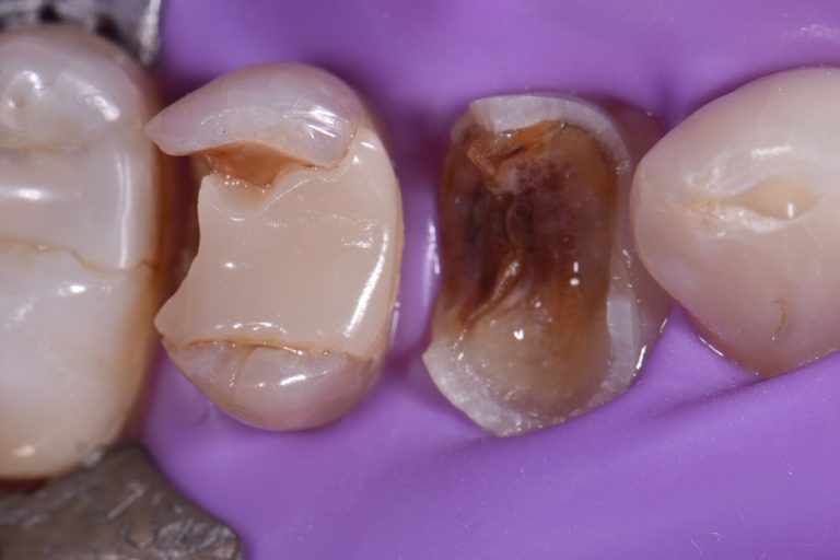 Restoration of Severely Broken Down Teeth