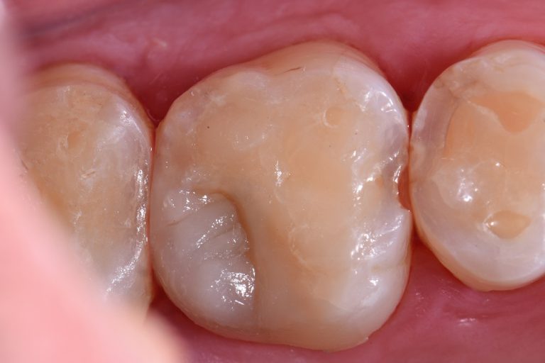 Stabilizing Molar Hypomineralization