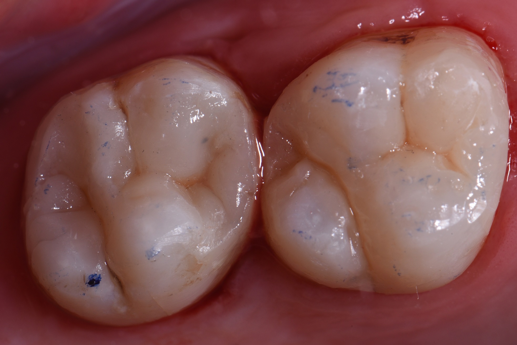 Large Fillings Sculpted Composite Resin Artistry Auckland Dentist