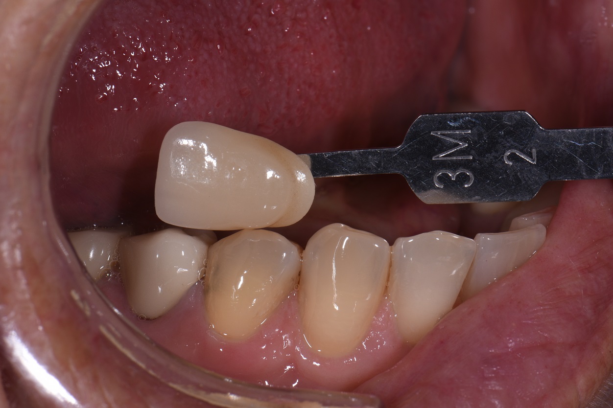 impression dental impression dental