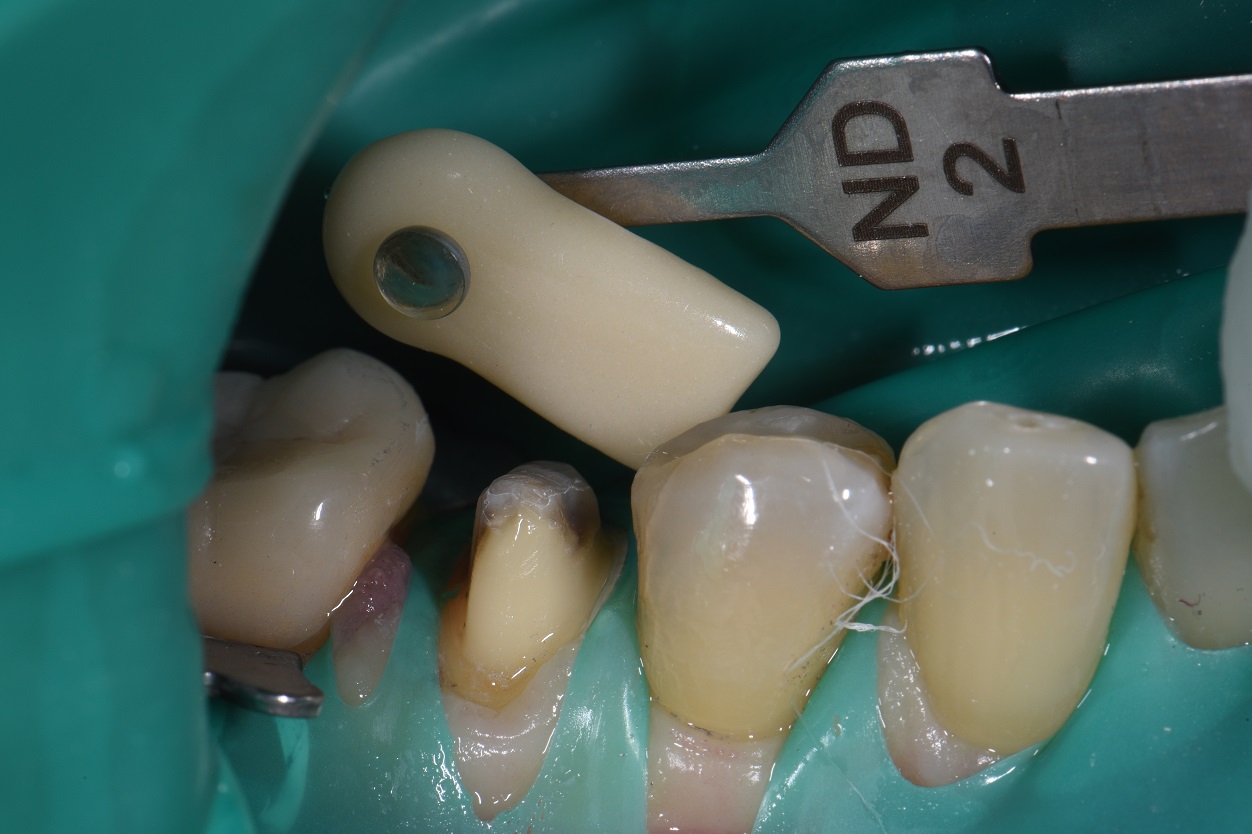 Final Dental Impressions Tam Dental Group Ltd.
