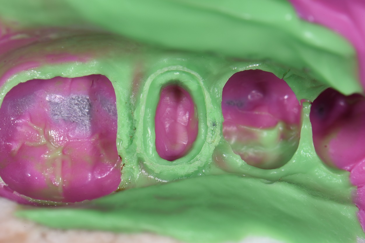 Final Dental Impressions Tam Dental Group Ltd.