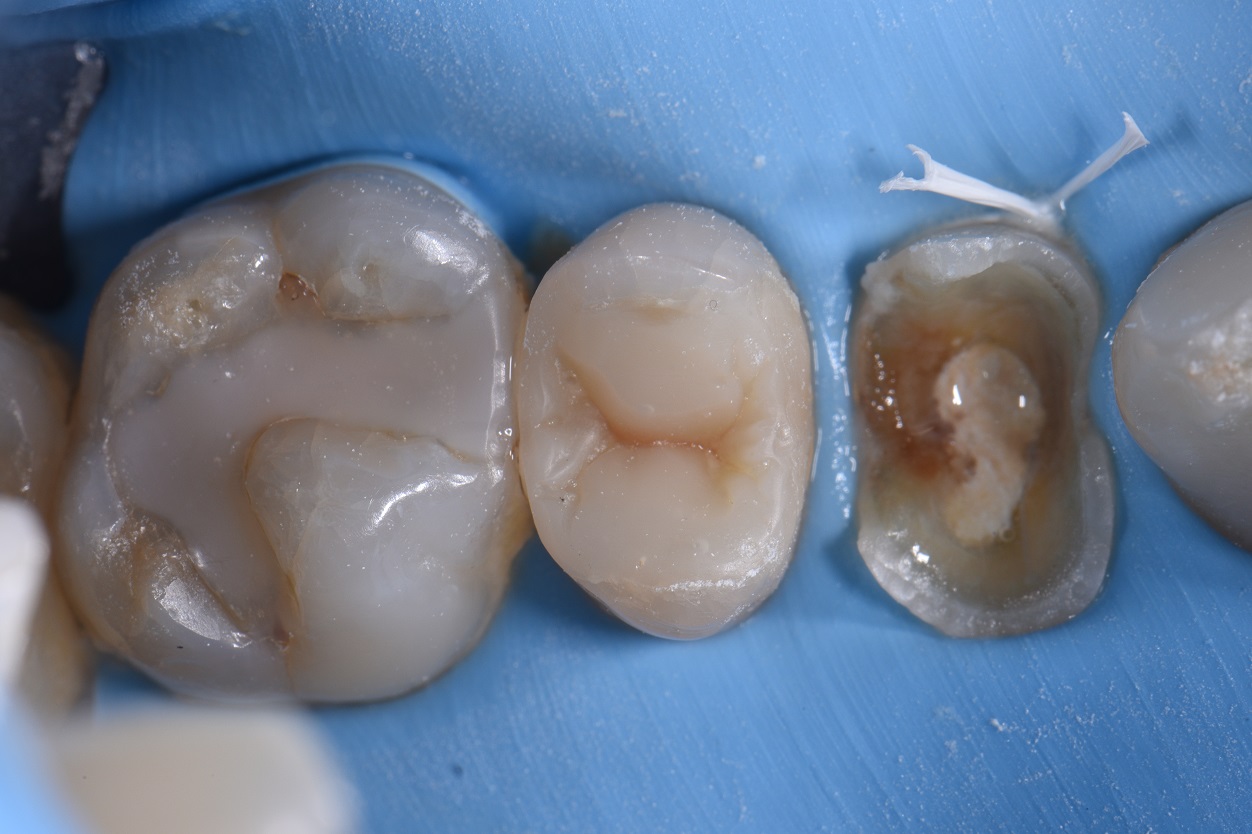 Rebuilding Near Hopeless Teeth Restorative Dentist Auckland