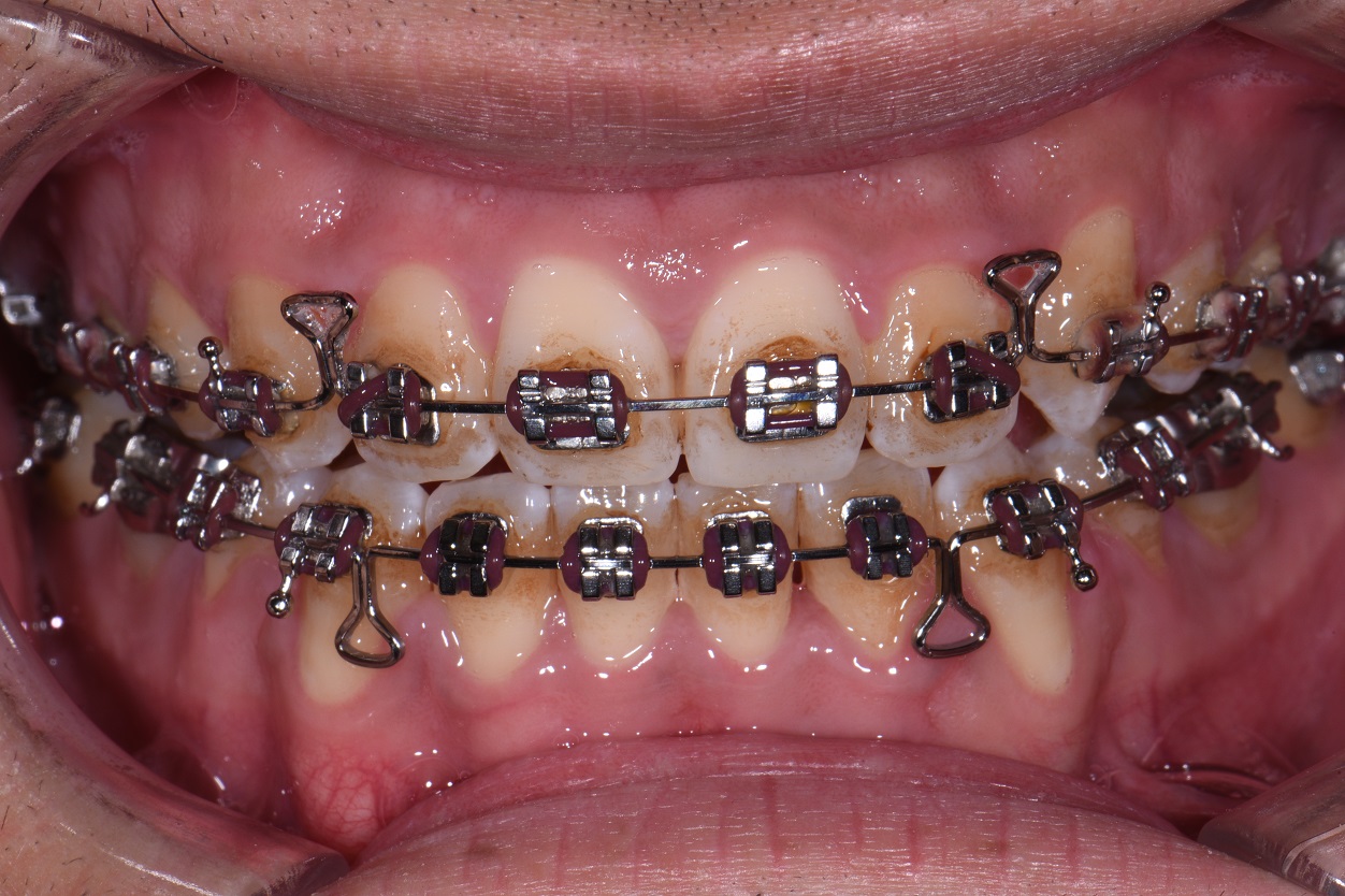 EMS Air Flow Stain Removal Around Braces