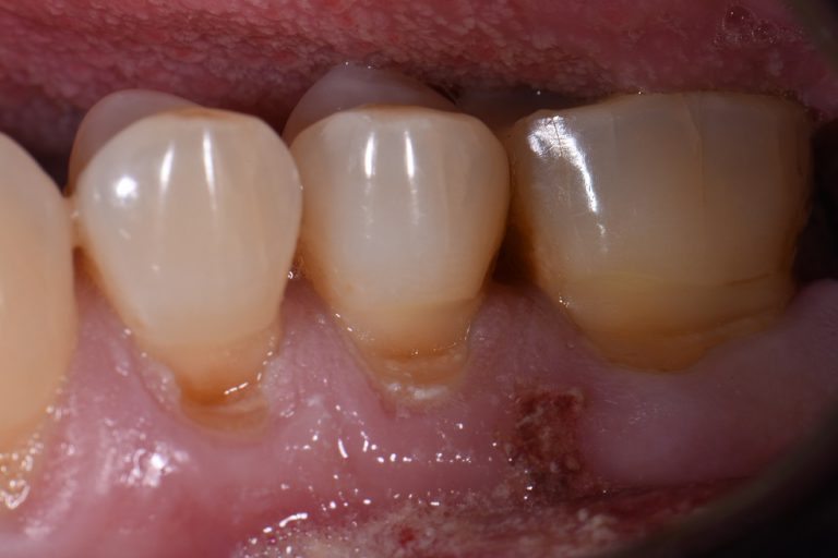 Cervical Abrasion Toothbrush Abrasion Restorative Dentistry