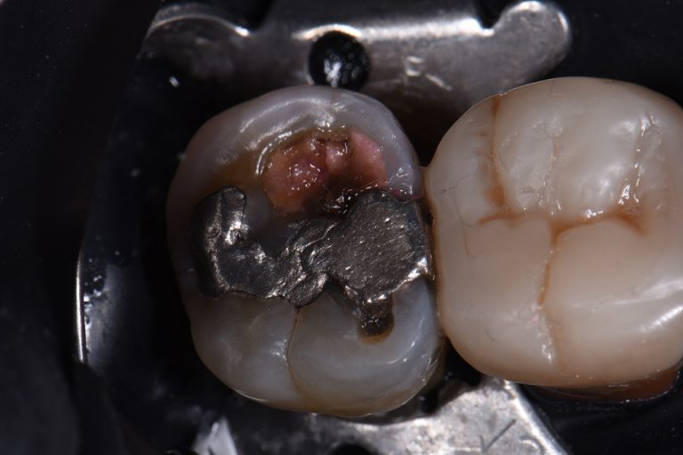 Removal of Amalgam Fillings Restorative Dentist Auckland