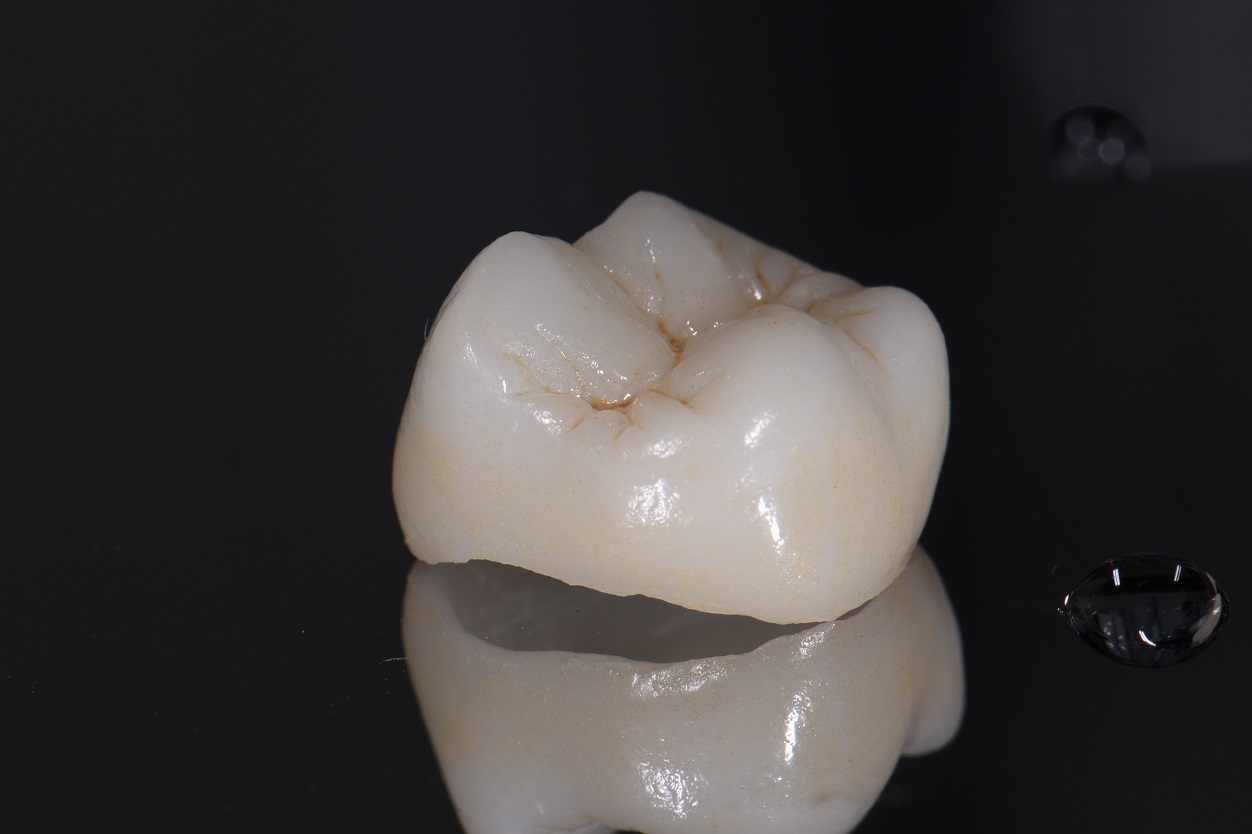 Beautiful Lithium Disilicate Crowns | Restorative Dentist Auckland
