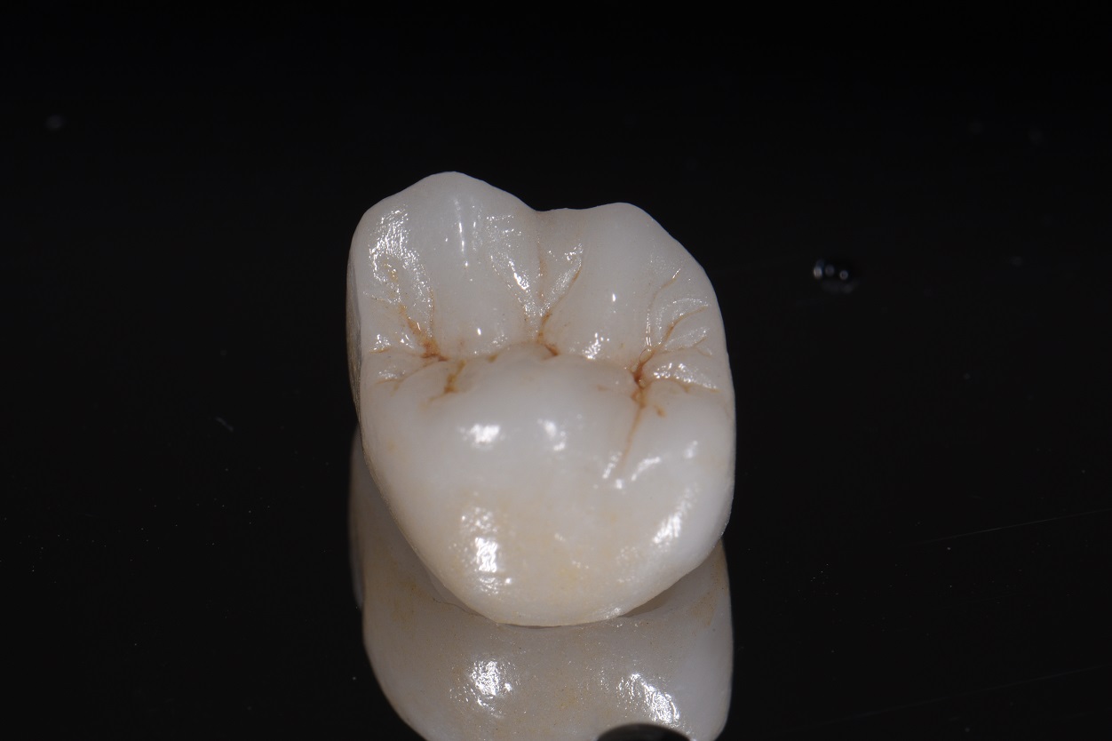 Beautiful Lithium Disilicate Crowns | Restorative Dentist Auckland