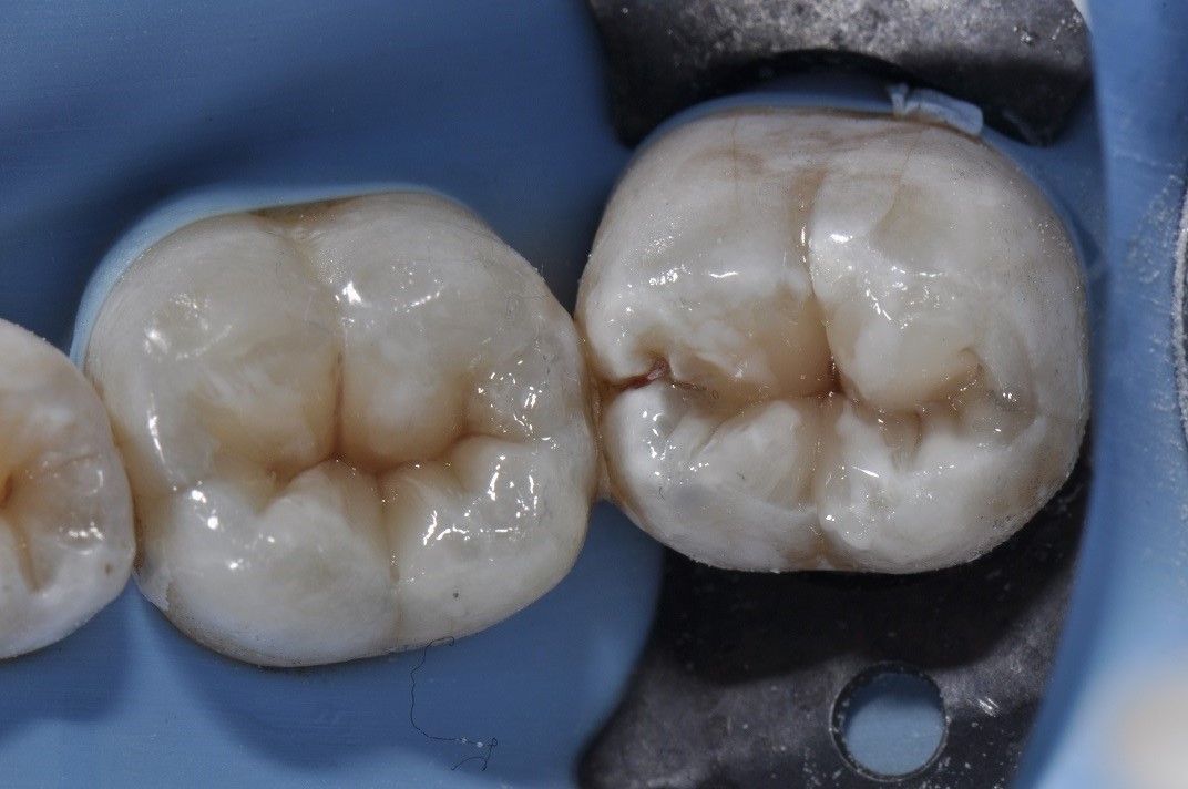 Amalgam Filling Removal AACD Cosmetic Dentist