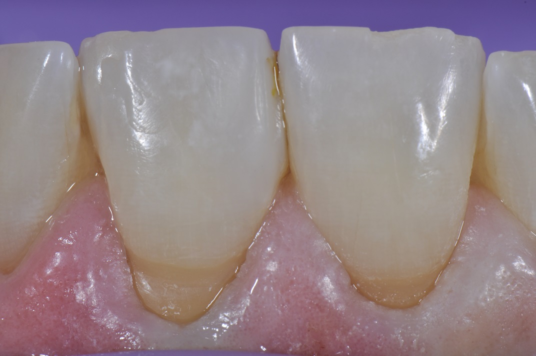 Cavities at the Bottom of Teeth by the Gumline Class V Composite