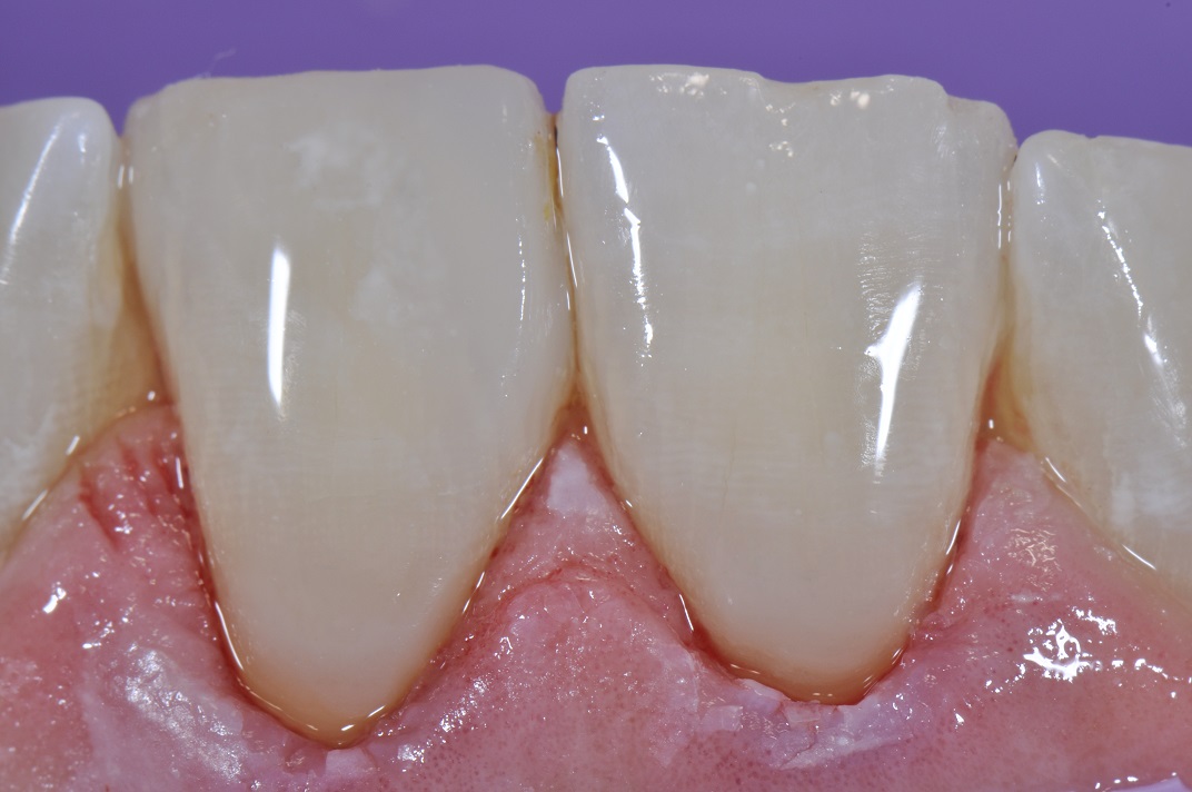 Cavities at the Bottom of Teeth by the Gumline Class V Composite