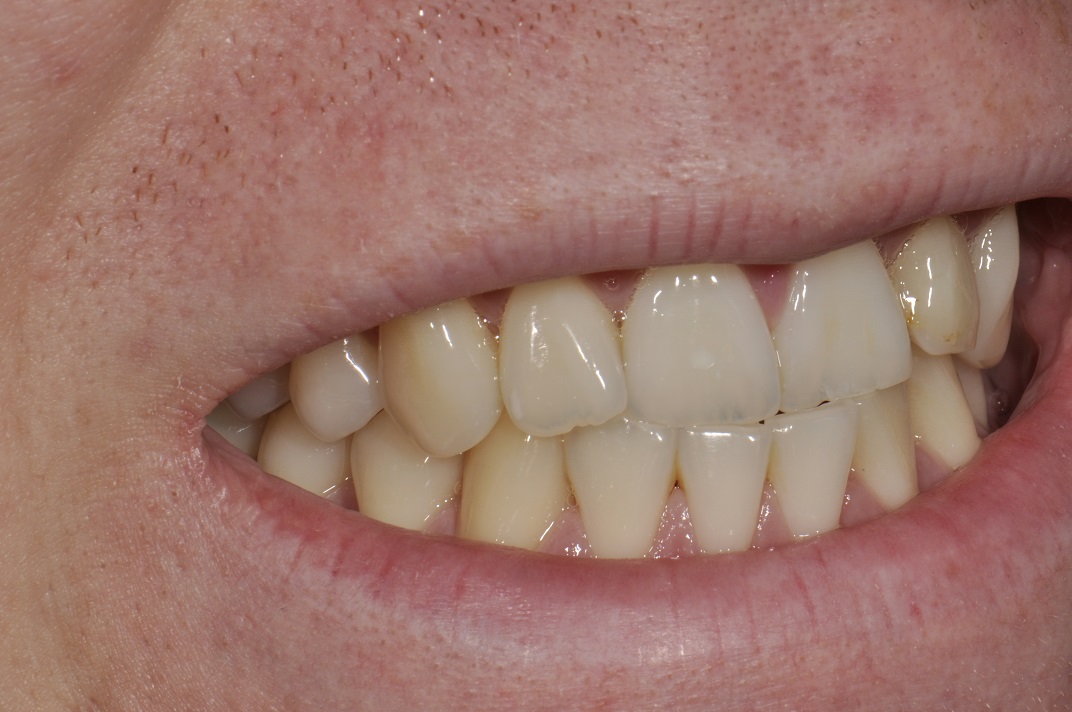 Invisalign Braces Bleach Bonding Minimally Invasive Cosmetic