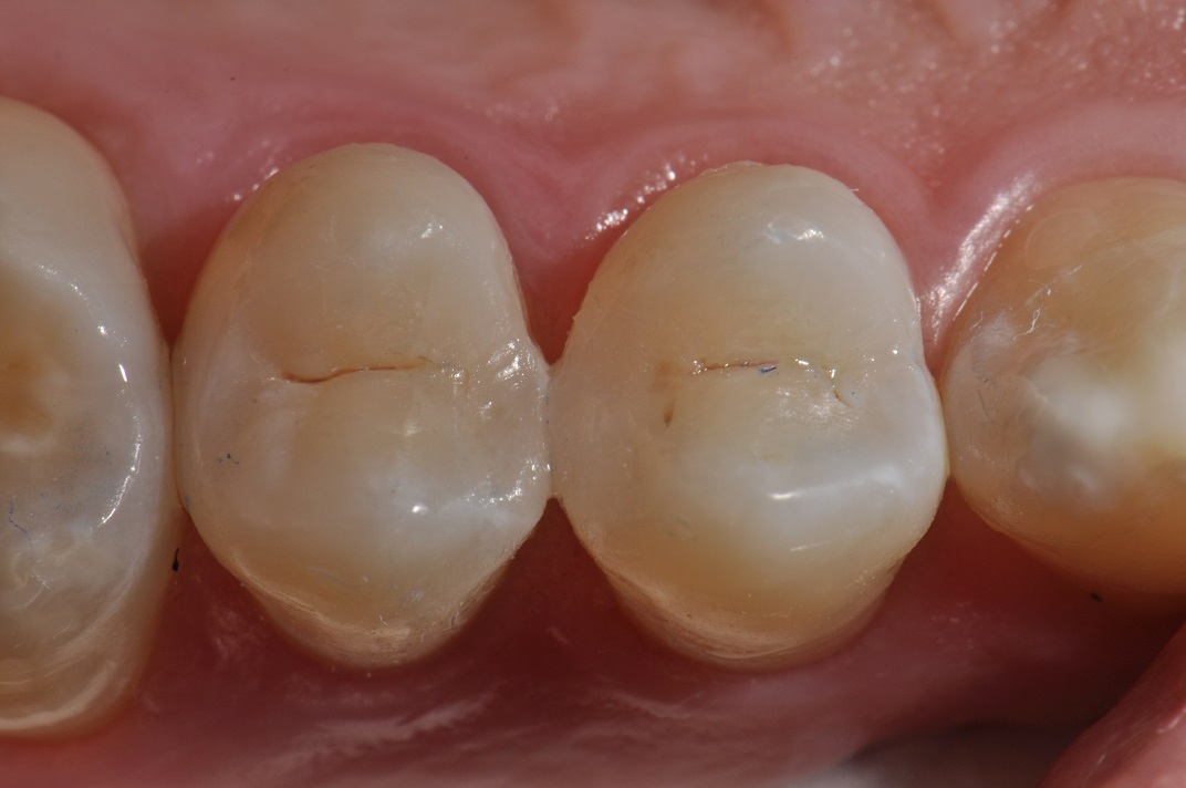 The Actual Extent of a Grade 3 (R3) Carious Lesion (Cavity)