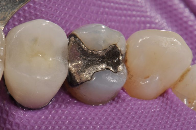Amalgam Replacement To Do or Not to Do