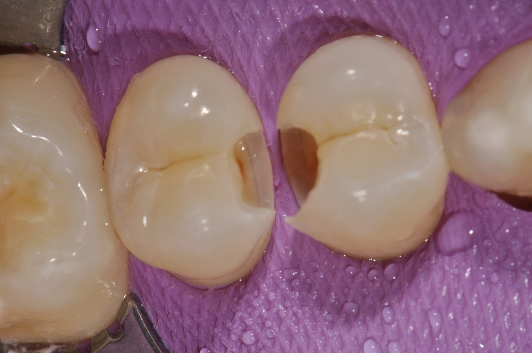 The Actual Extent of a Grade 3 (R3) Carious Lesion (Cavity)
