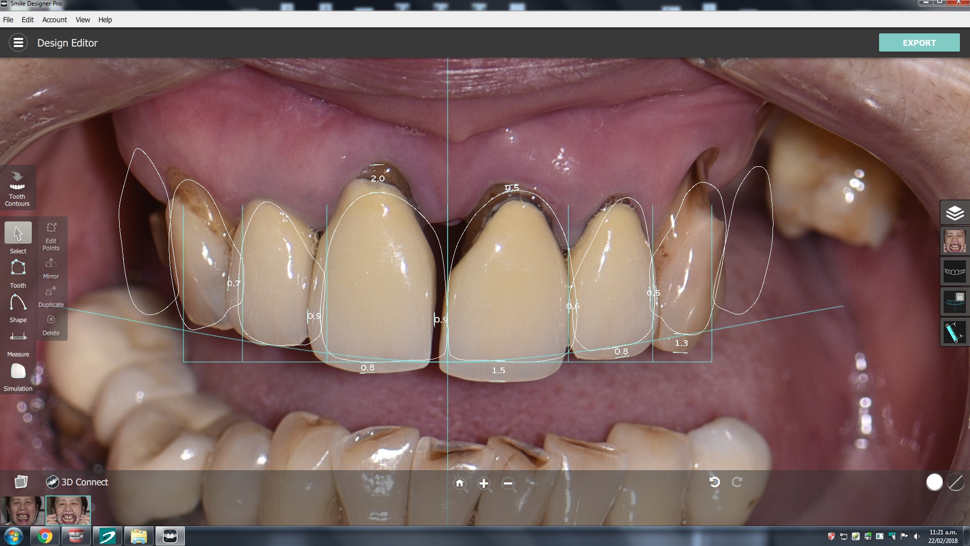 Kois Deprogrammer and OVD setup for dental rehabilitation