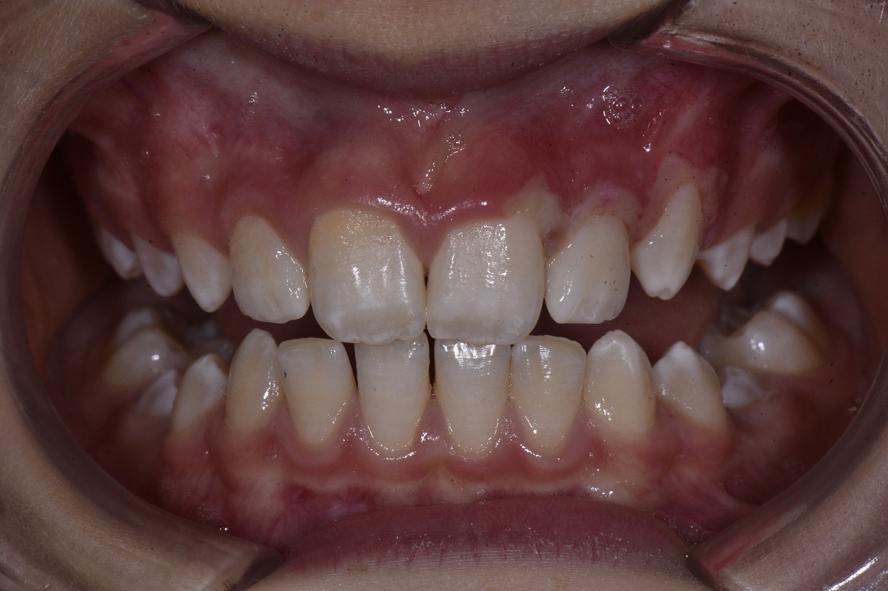 Mouth Ulcers | Acute Necrotizing Ulcerative Gingivitis | Laser Treatment