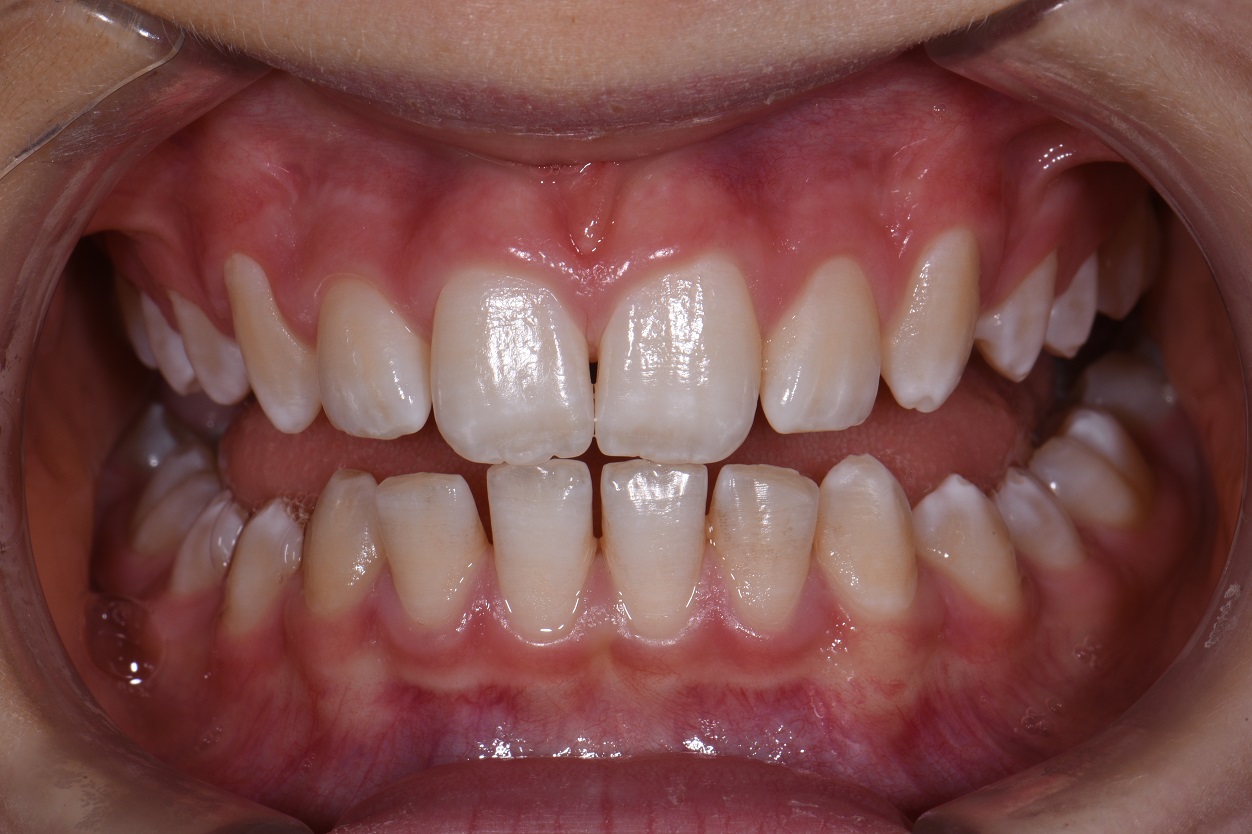 Mouth Ulcers | Acute Necrotizing Ulcerative Gingivitis | Laser Treatment