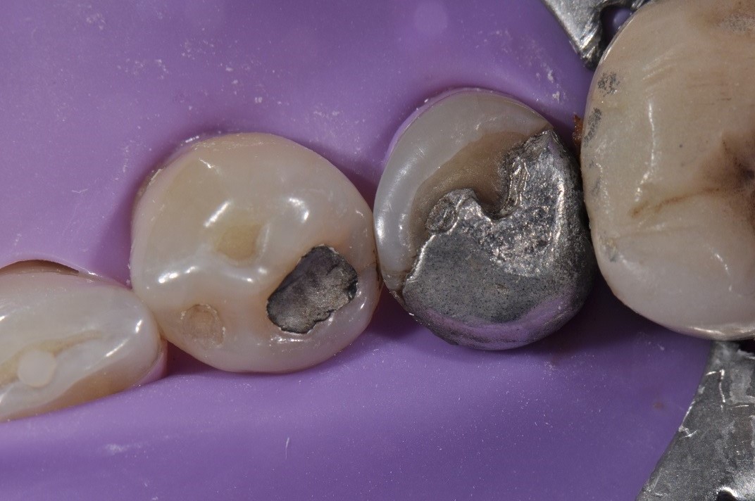Replacement of Large Amalgam Fillings Tam Dental Group Ltd.