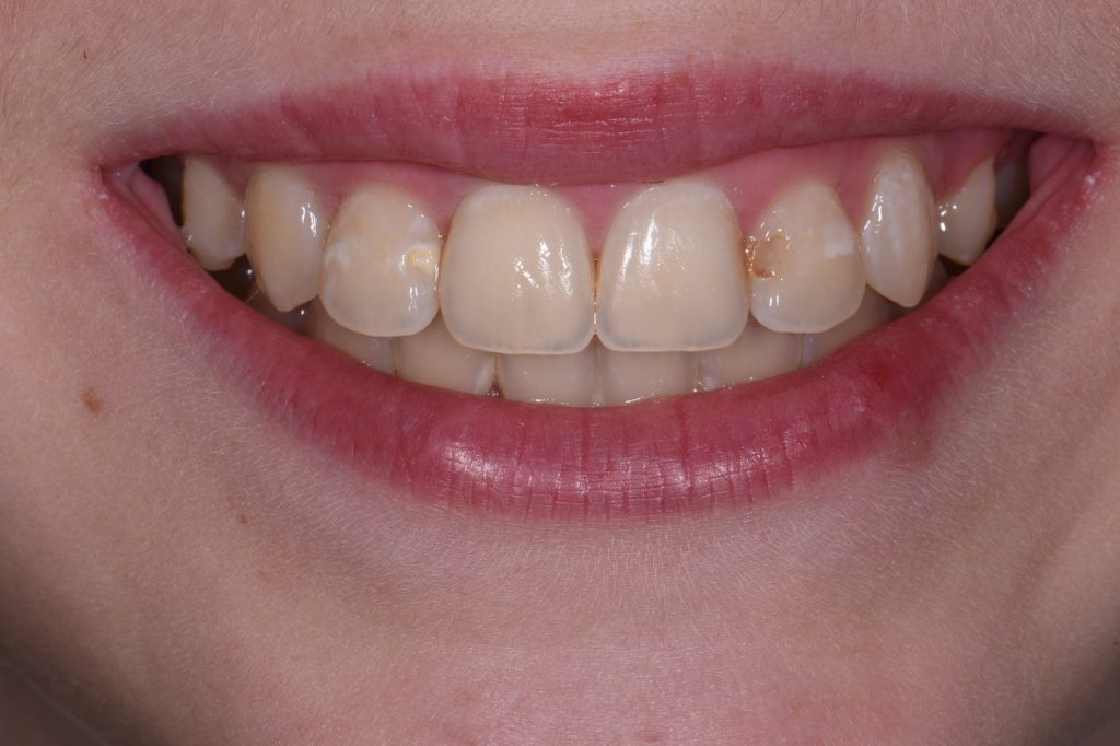 Exposed Cavities Between Front Teeth AACD Cosmetic