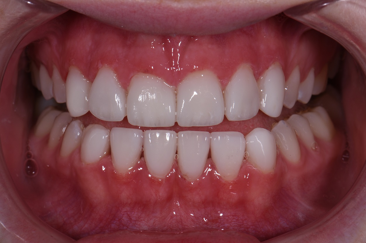 Closing Spaces Between Teeth Microdontia Cosmetic Dentist AACD
