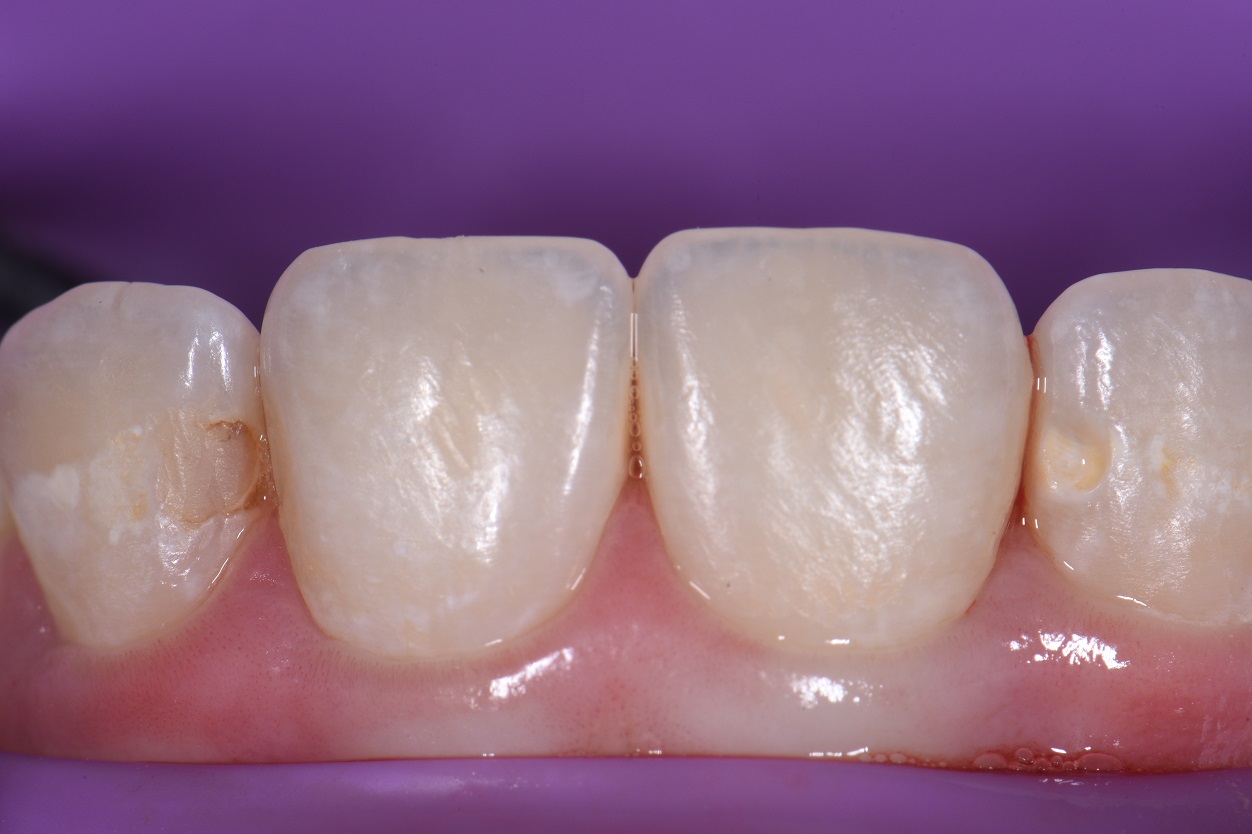 Back to back Cavities between the front teeth Restorative Dentist