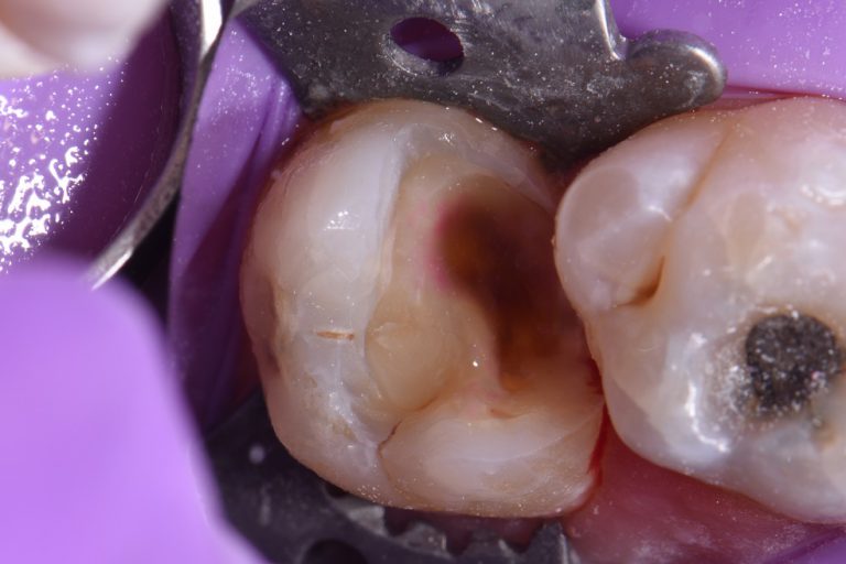 Large, Broken Down Teeth AACD Restorative Dentist