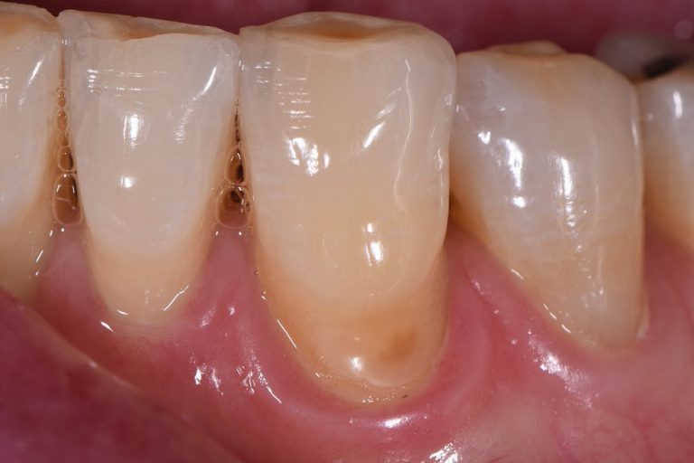 Exposed Root and Dentin Wear AACD Accredited Restorative Dentist Auckland