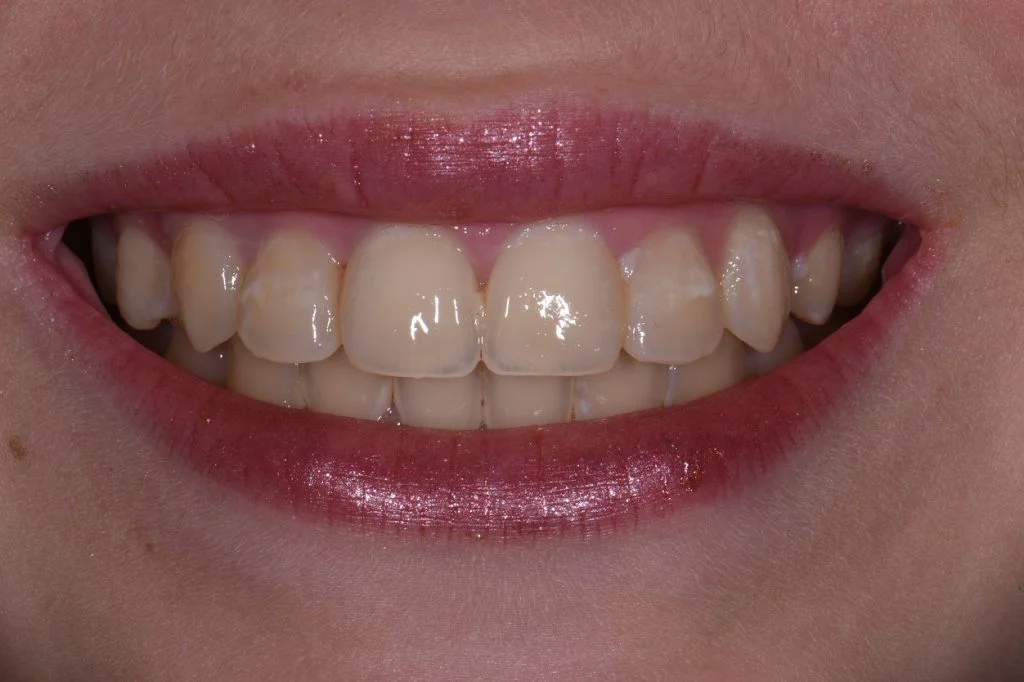 Exposed Cavities Between Front Teeth AACD Cosmetic