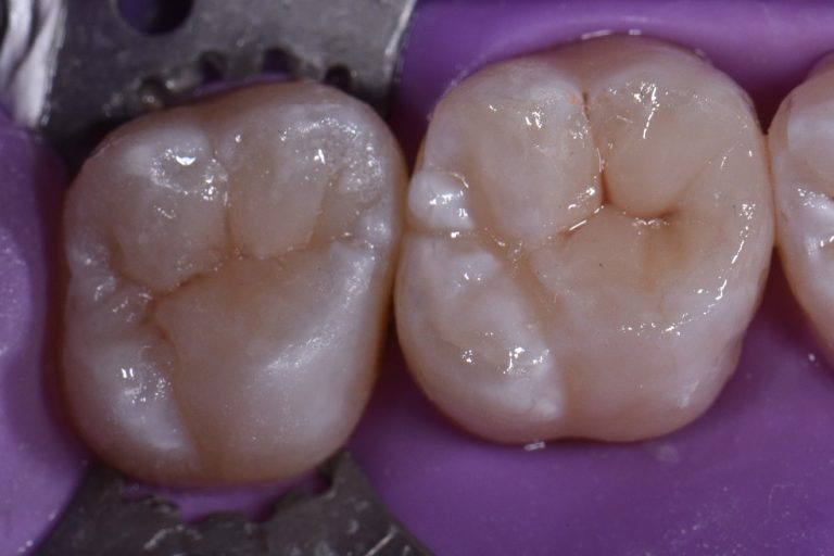 Cracks In Teeth And Large Filling Replacements