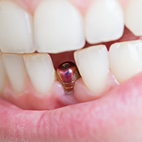 Dental Implants