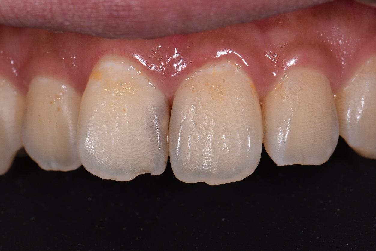 Kerr Harmonize Derotation of Tooth 11
