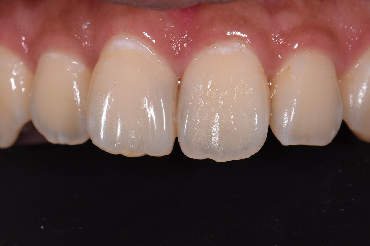 Kerr Harmonize Derotation of Tooth 11