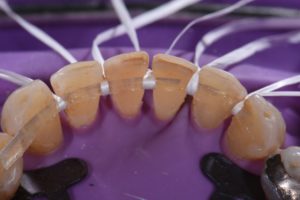 Stabilizing Mobile Teeth | Periodontal Splinting