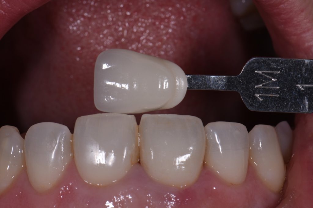 Zirconia Crowns Blending Beautifully with Natural Teeth
