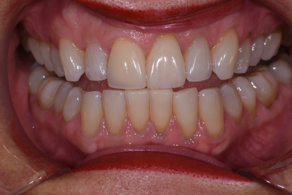 Changing Old Fillings to Make Teeth Look Virgin