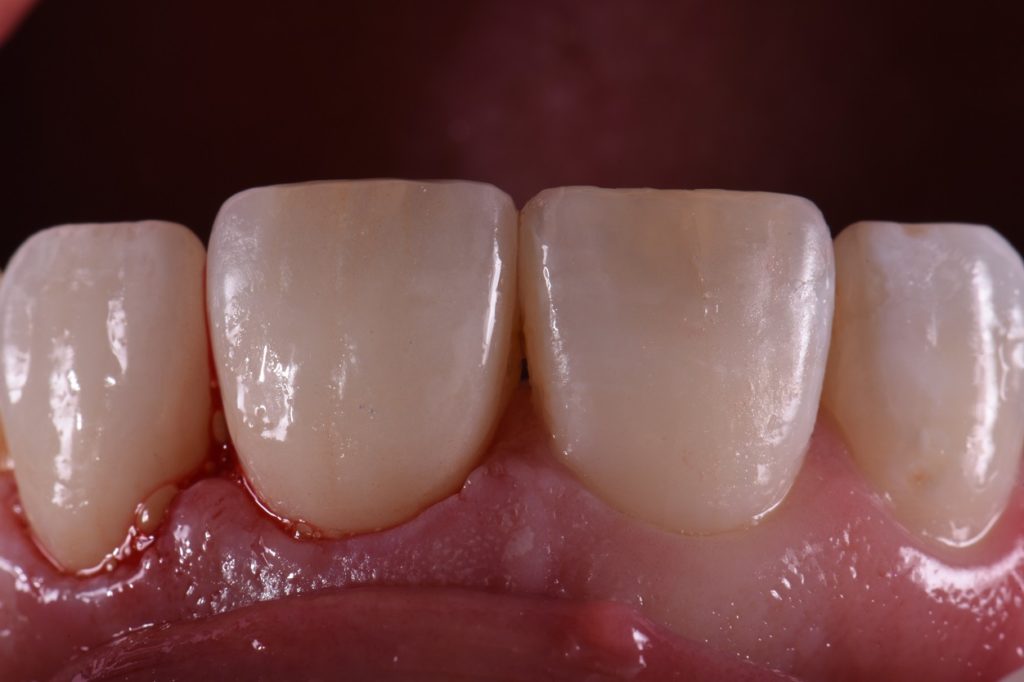 Matching Two Artificial Teeth in a Sea of Natural Teeth
