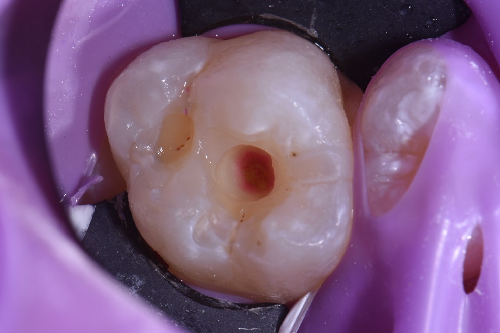 Deep recurrent cavities under a fissure sealant