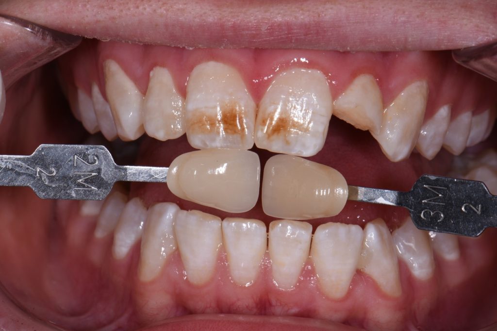 Whitening Instead of Veneers