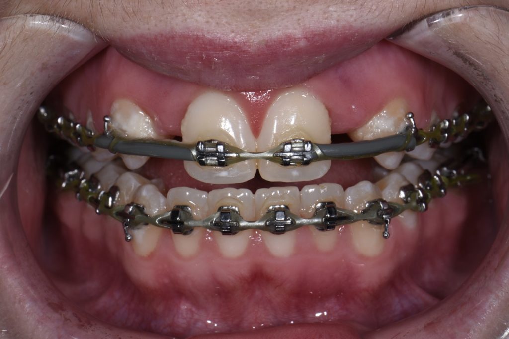 Temporary Immediate Direct Implant Crowns