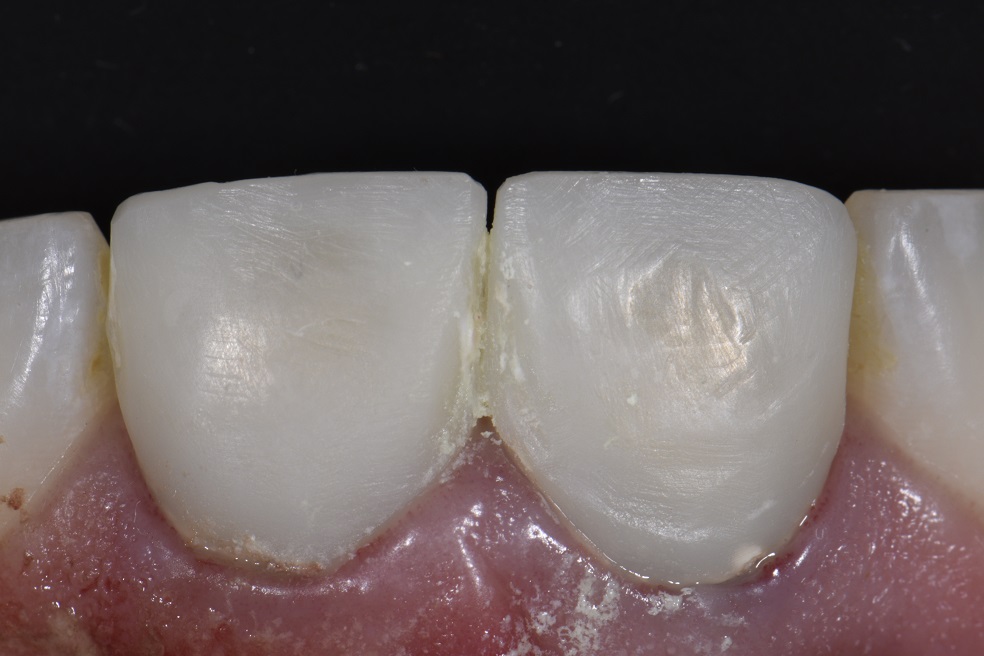 Modification of Temporary Crowns for Improved Color and Contour
