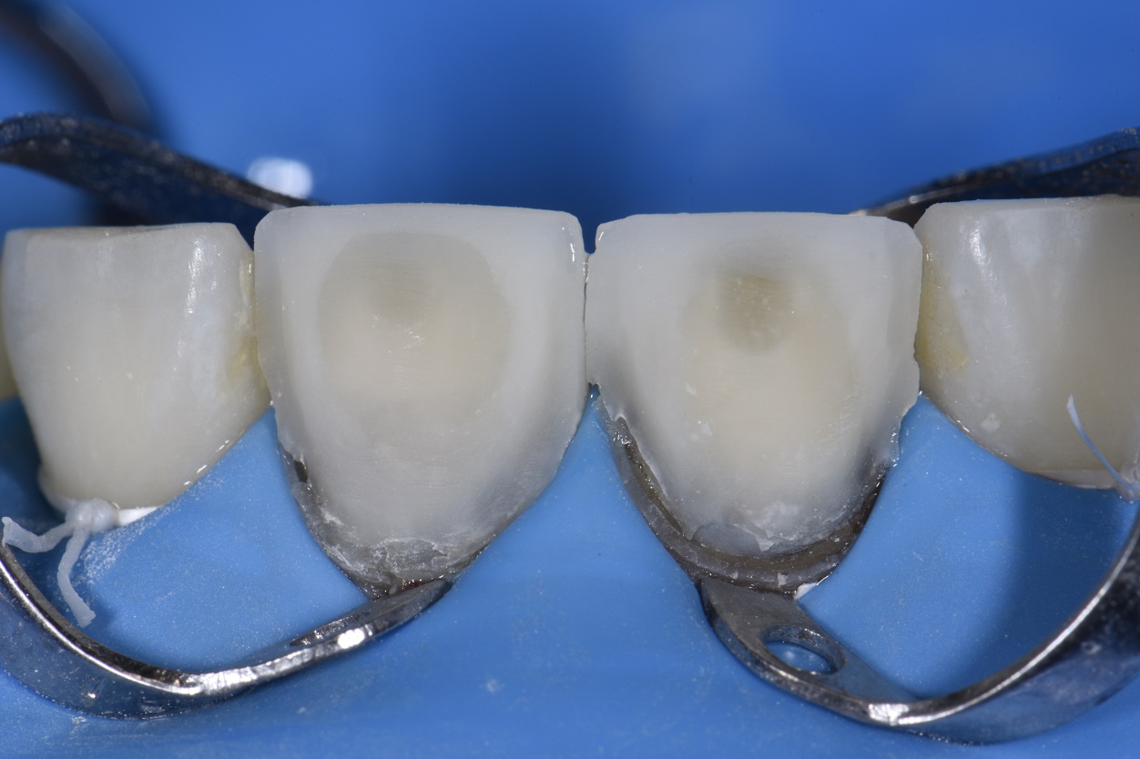 Modification of Temporary Crowns for Improved Color and Contour