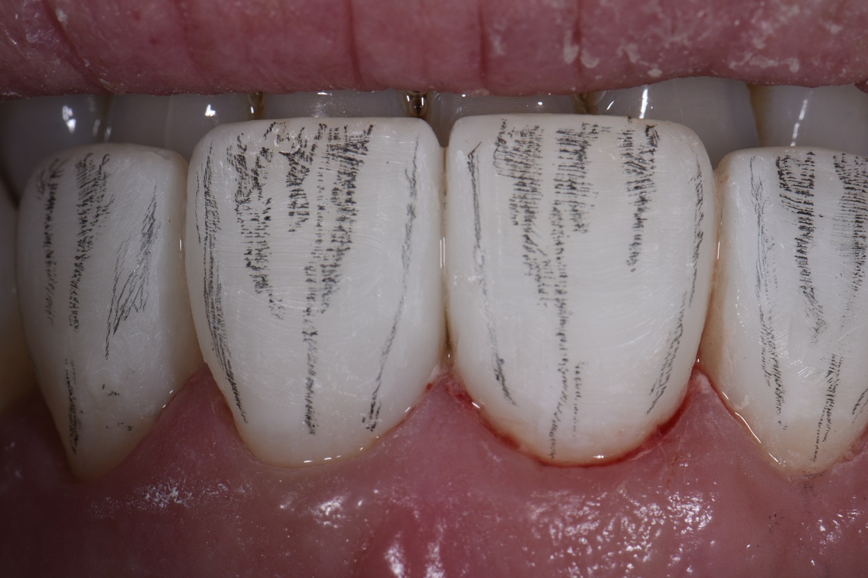 Resin additions without Any Tooth Removal