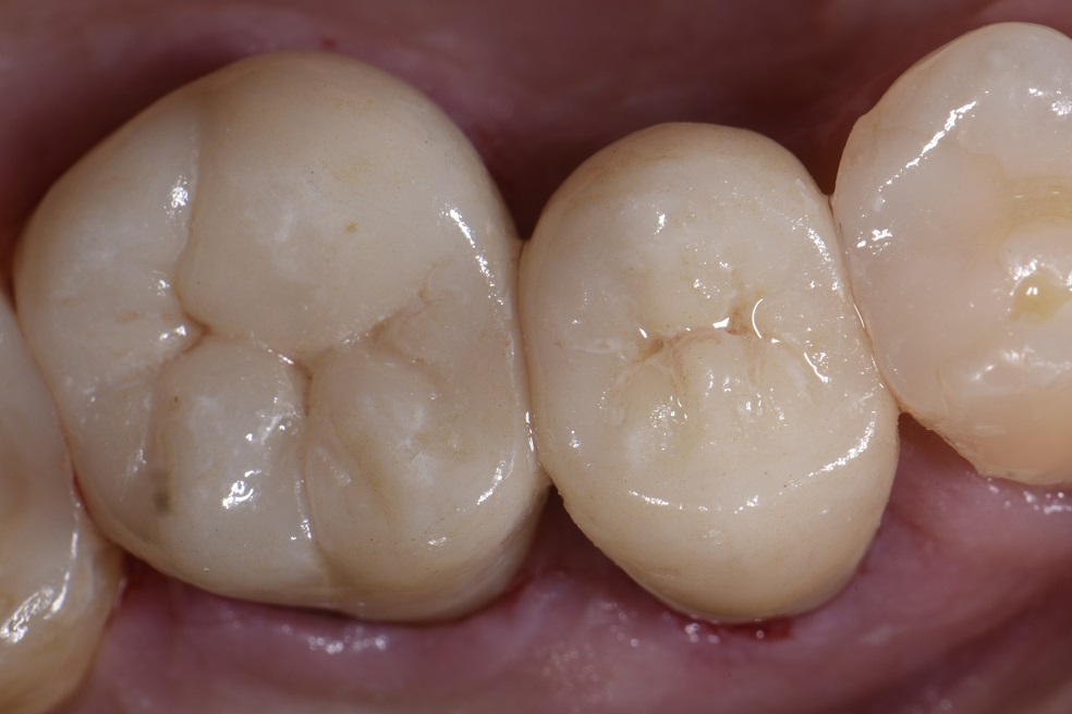 Rebuilding and Reconstructing Complex Teeth