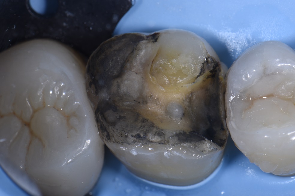 Adhesive Onlays in Restorative Dentistry